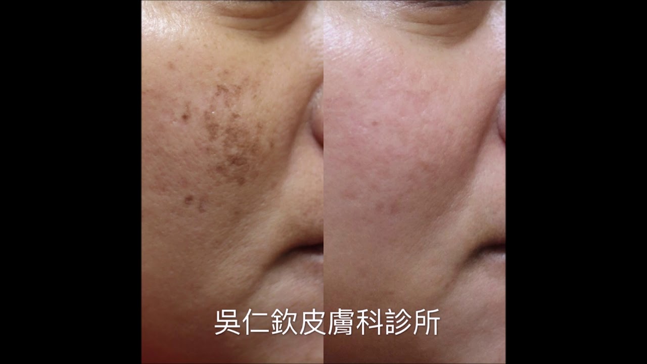 探索皮秒-吳仁欽皮膚科診所