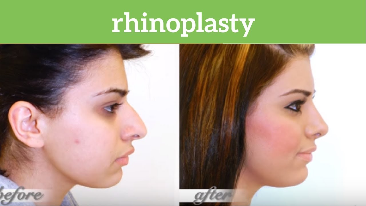 Lift MD Aesthetics Beverly Hills: Rhinoplasty Plastic Surgery by Dr. Garo Kassabian