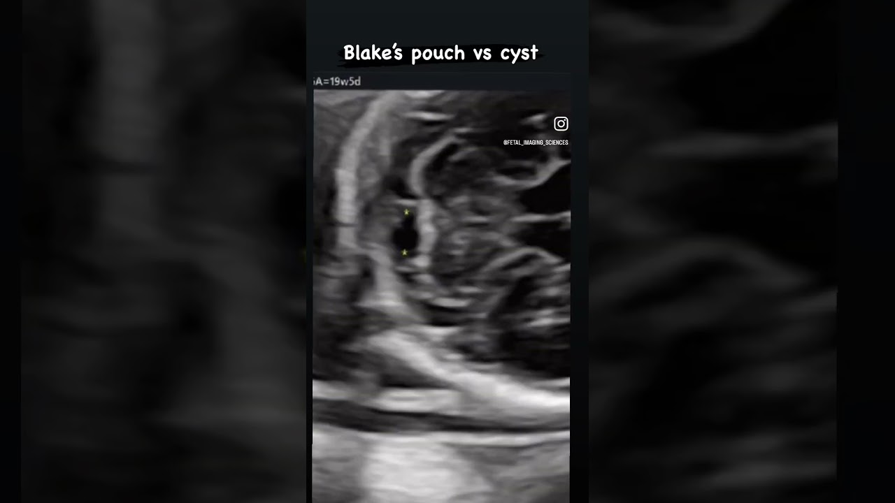 #fetalmedicine #fetalecho #ultrasound #isuog