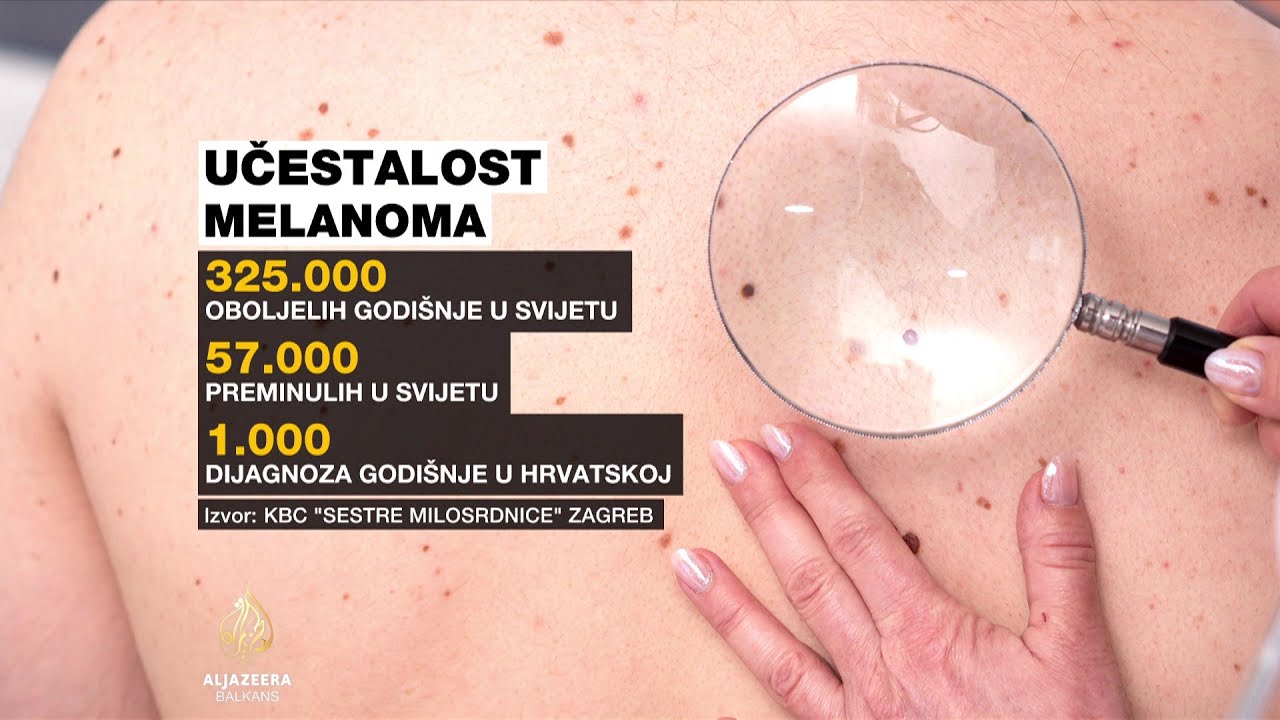 Hrvatska četvrta u EU po smrtnosti od melanoma