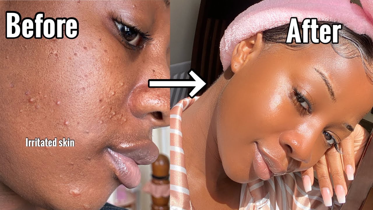 MY UPDATED SKINCARE ROUTINE!!!! |  *New and Improved*  (ACNE PRONE SKIN)