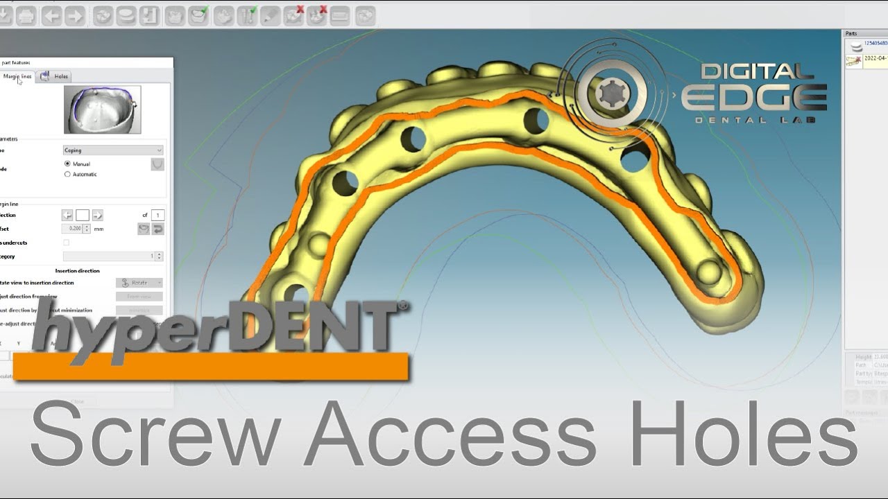 hyperDENT Tutorial: Angulated Screw Channels