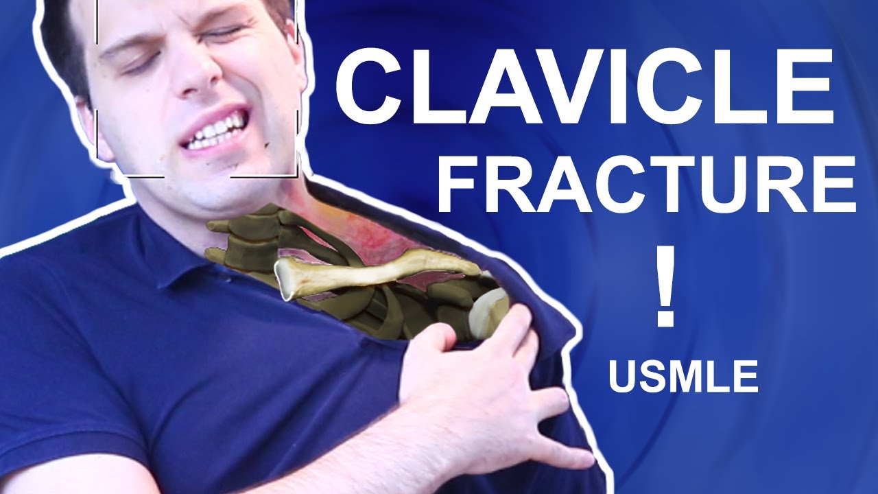 Clavicle Fracture - Recovery and Dangerous Complications USMLE 1