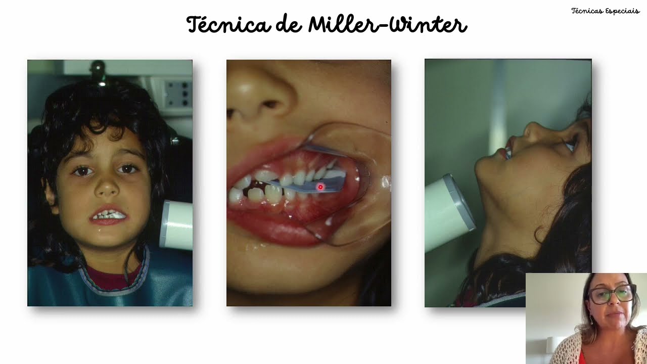 Métodos de Localização Radiográfica - Parte2: Técnicas de Miller-Winter e Donovan