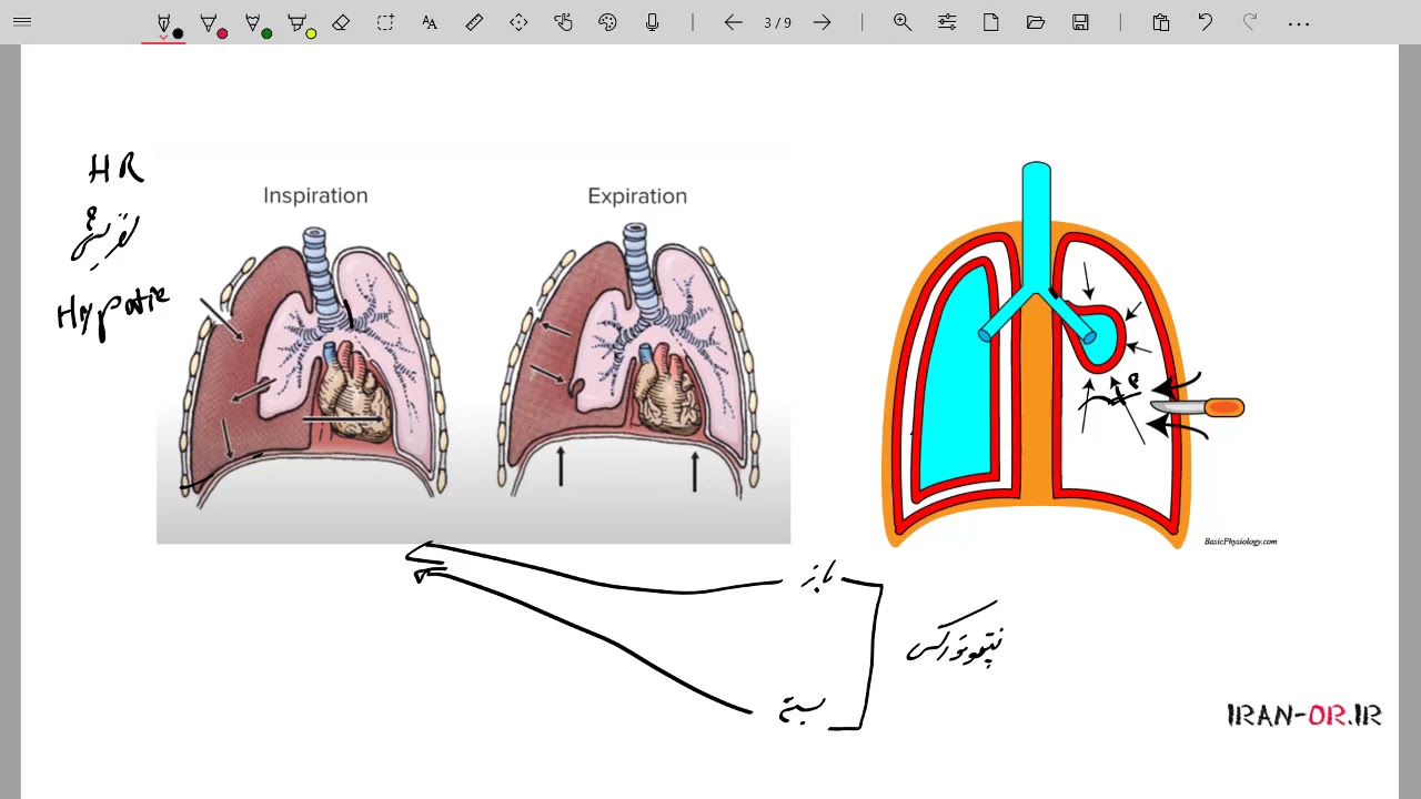 Pneumothorax پنوموتوراکس (وجود هوا در قفسه سینه) چیست ؟