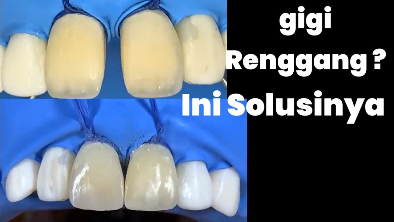 Gigi Renggang? Ini Solusinya !