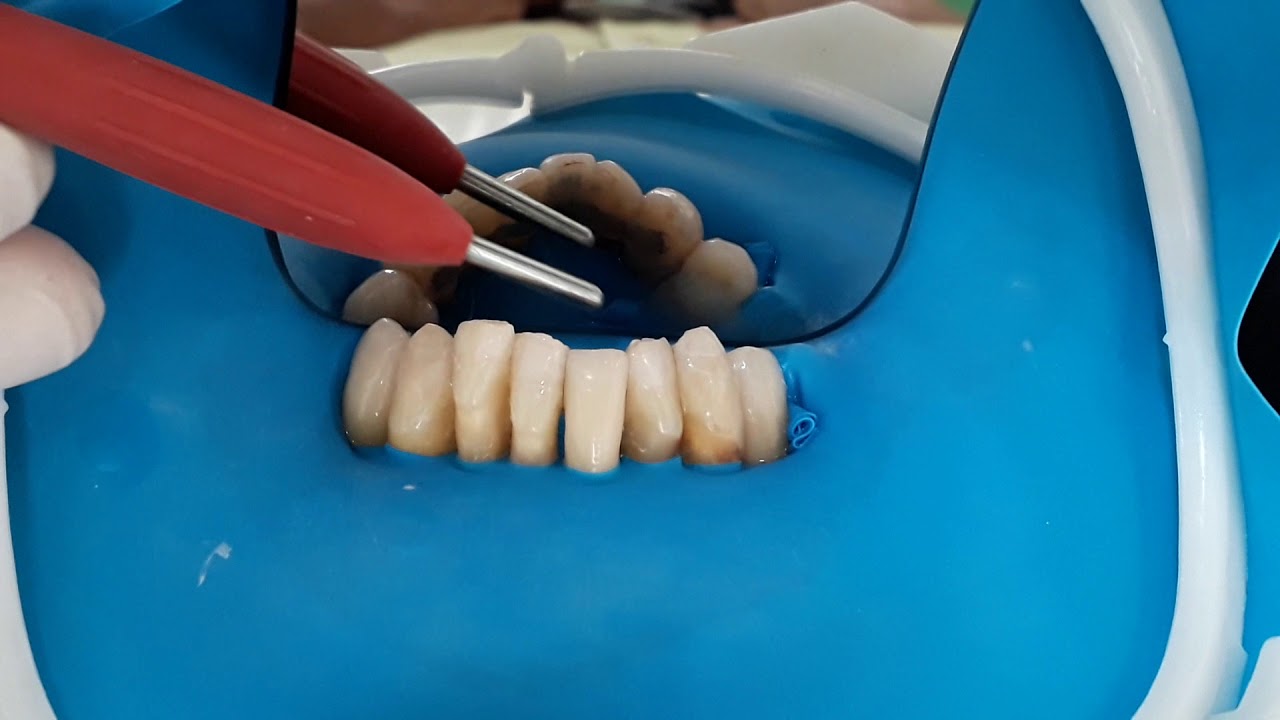 Contenção periodontal estética