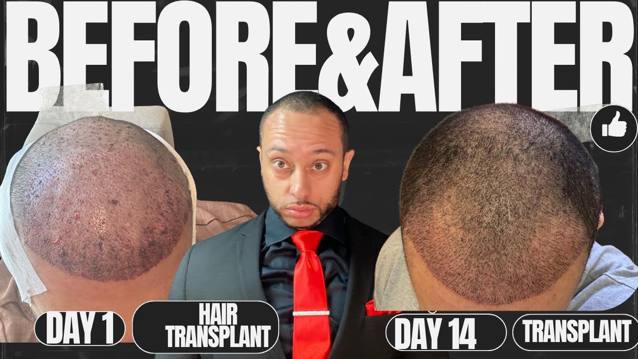 Hair Transplant in Turkey | Hair Transplant Patient Review