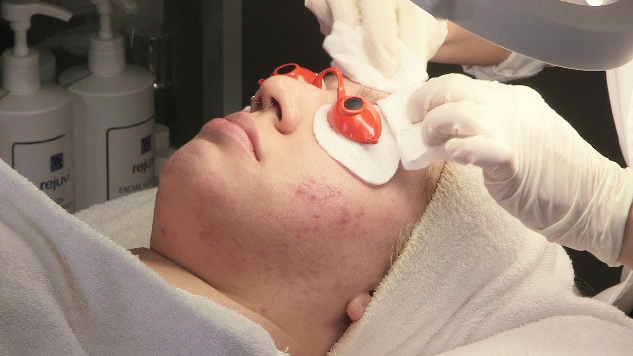 Acne Facial Treatment And Analysis