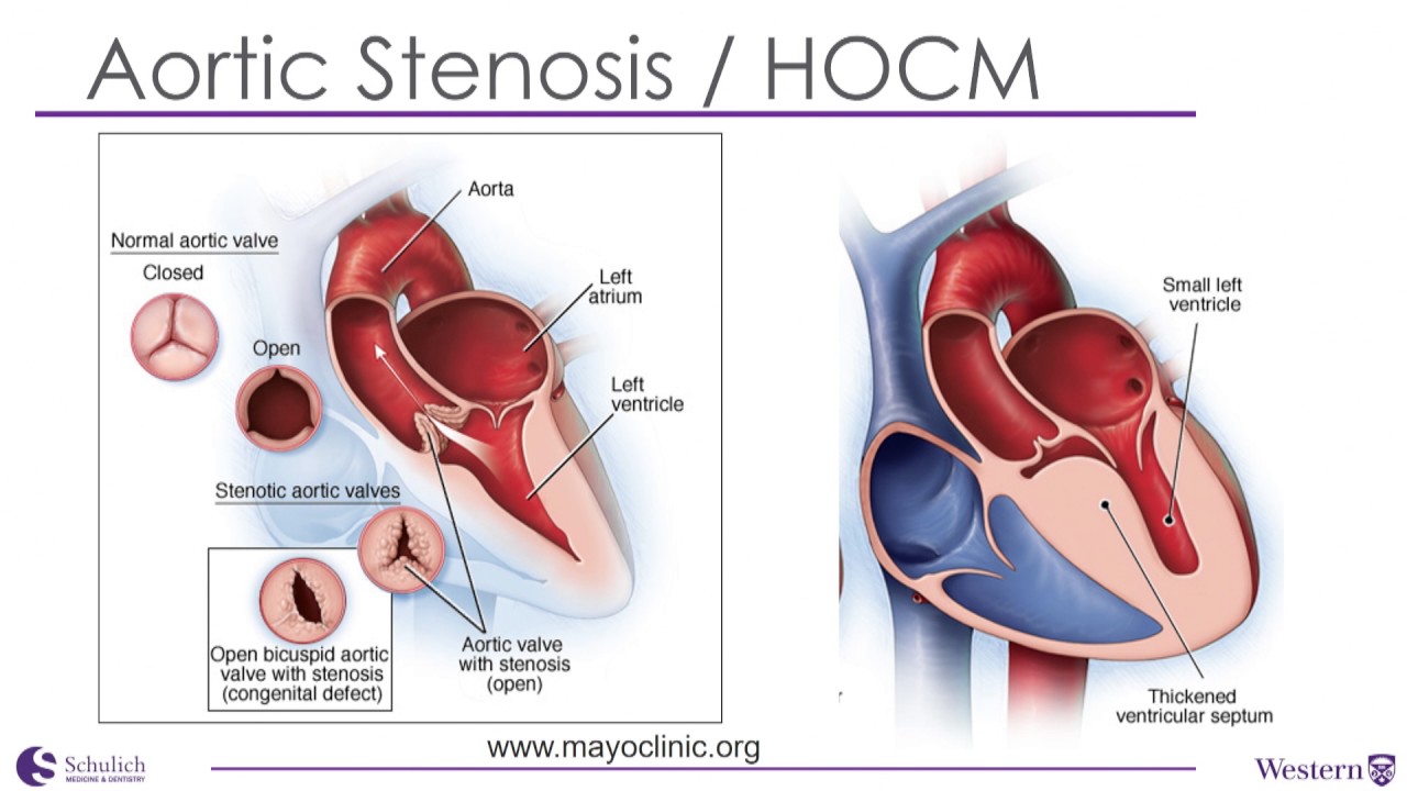 SYNCOPE: WHEN TO WORRY (Peter Leong-Sit) H&S Clinical Update Plenary Part 2of3