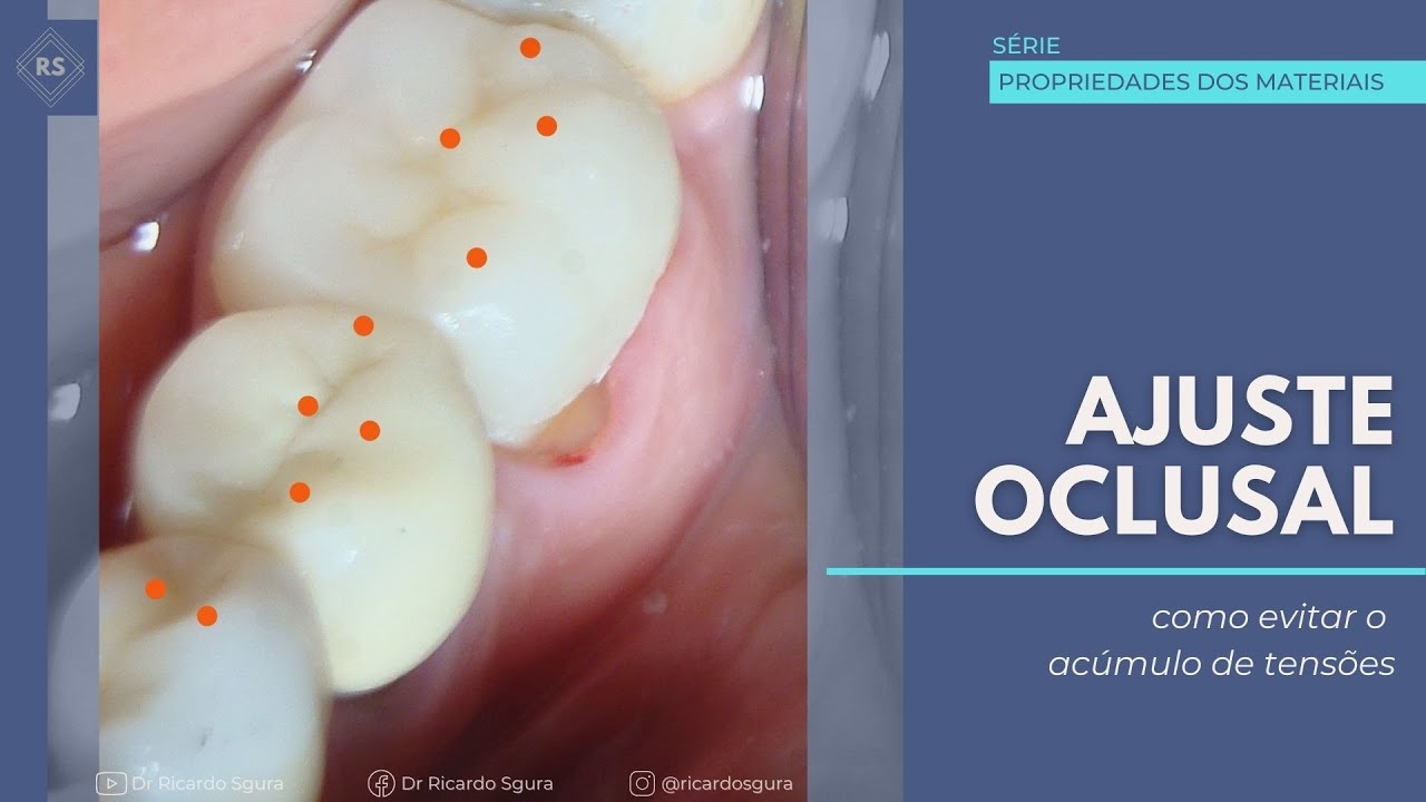 Ajuste Oclusal  - Como evitar o acúmulo de tensões.
