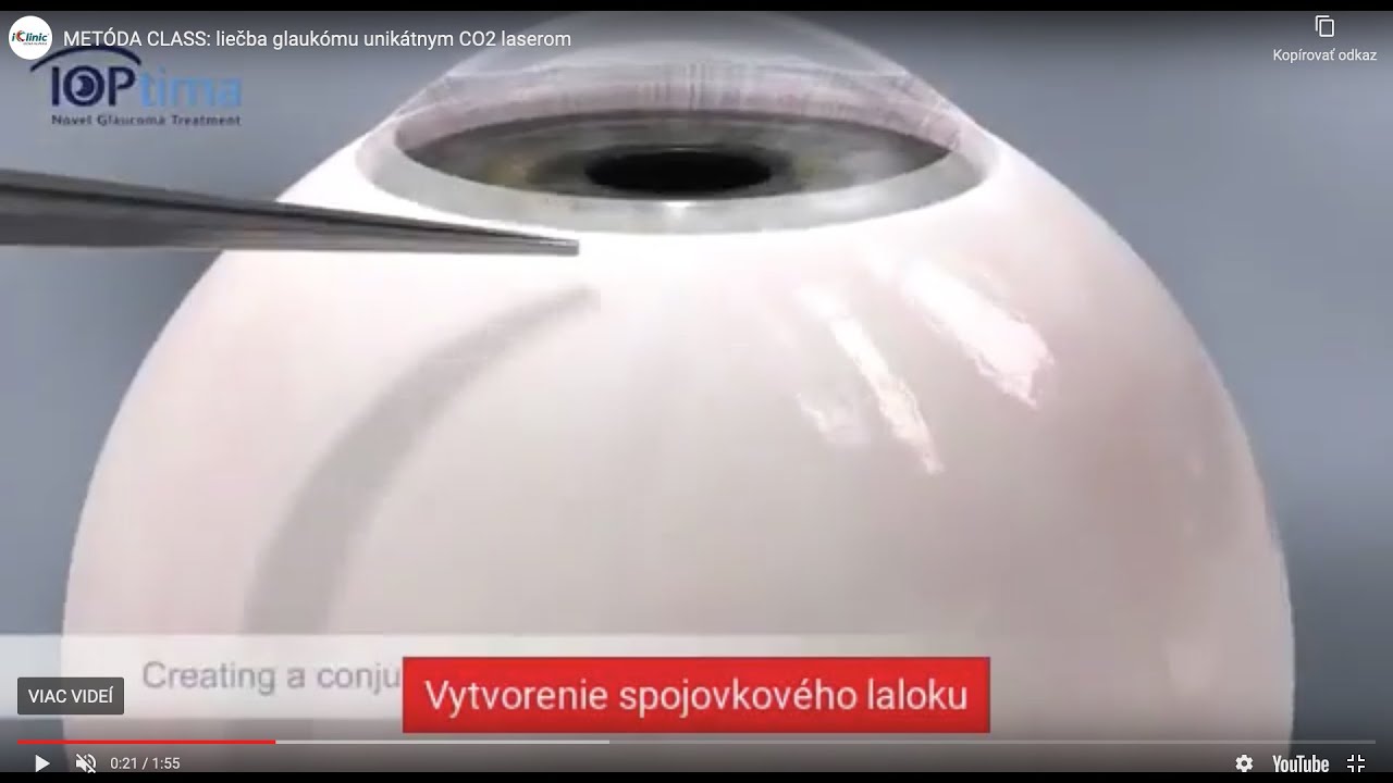 METÓDA CLASS: liečba glaukómu unikátnym CO2 laserom
