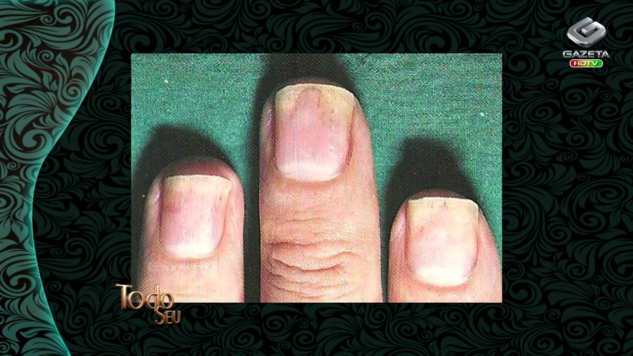 Todo Seu - Qual é sua Dúvida: Marcas e problemas nas unhas (06/11/13)