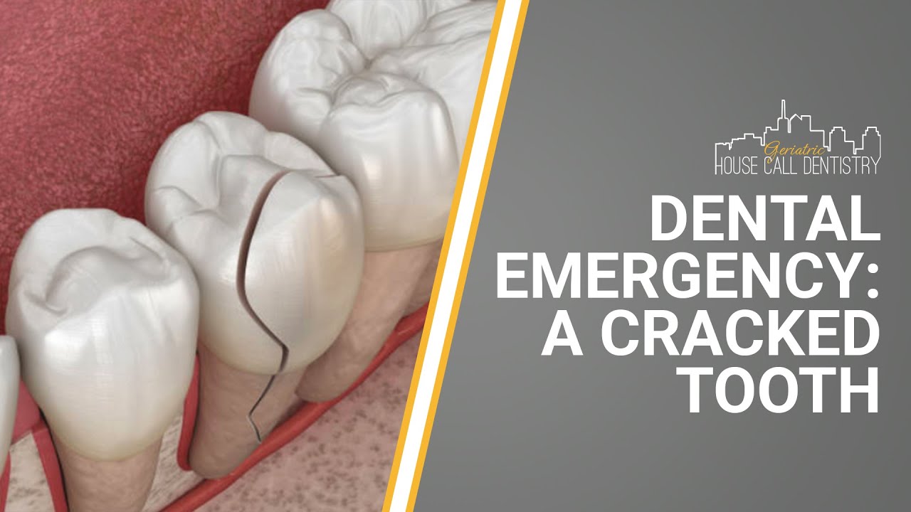 Dental Emergency: A Cracked Tooth