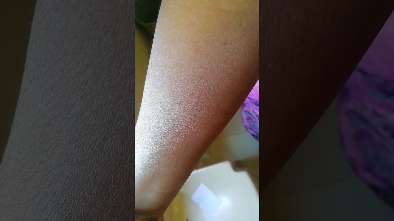 Urticaria, dermatographism test