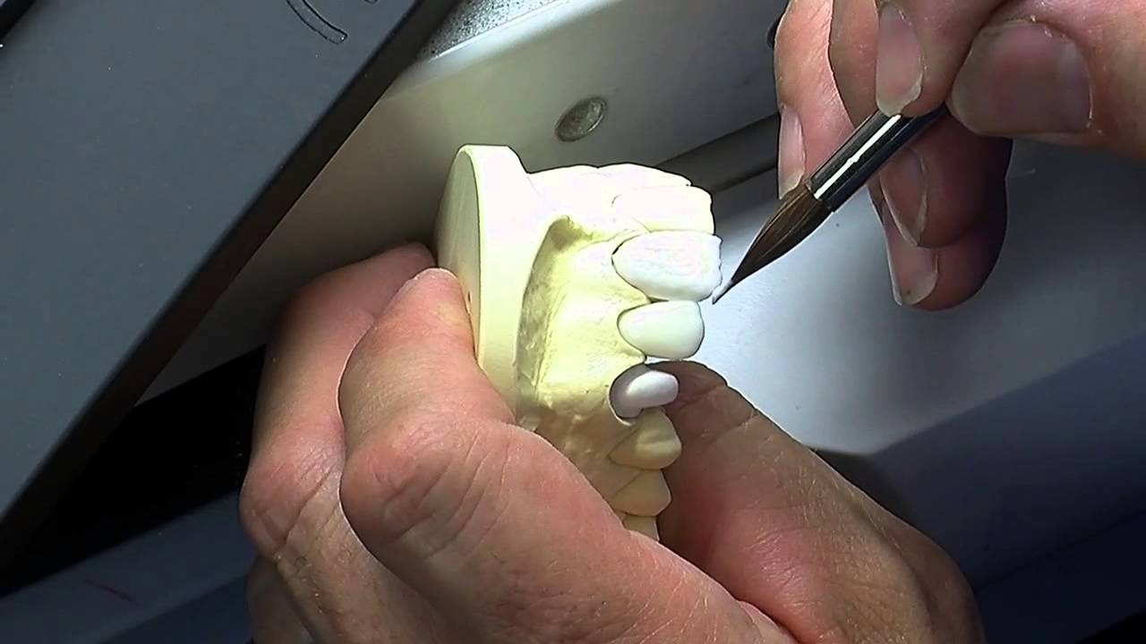 Overlaying enamel   central incisor