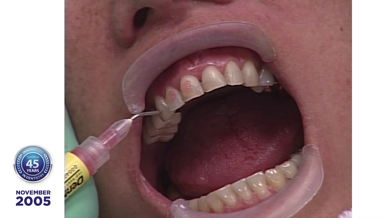 Dr. Robert Ibsen Presents Bev S., a Lumineers® Clinical Case Presentation: 2005