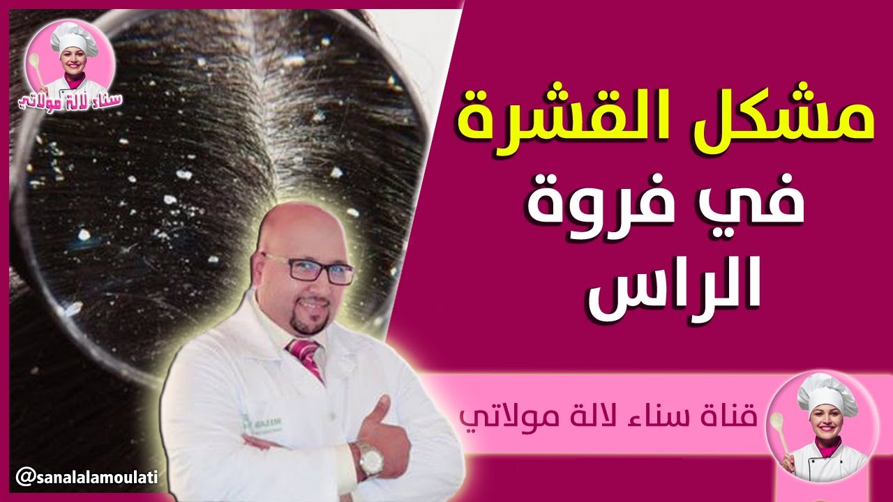 القشرة في فروة الراس وكيفاش نتخلصو منها مع الدكتور عماد ميزاب Dr imad Mizab