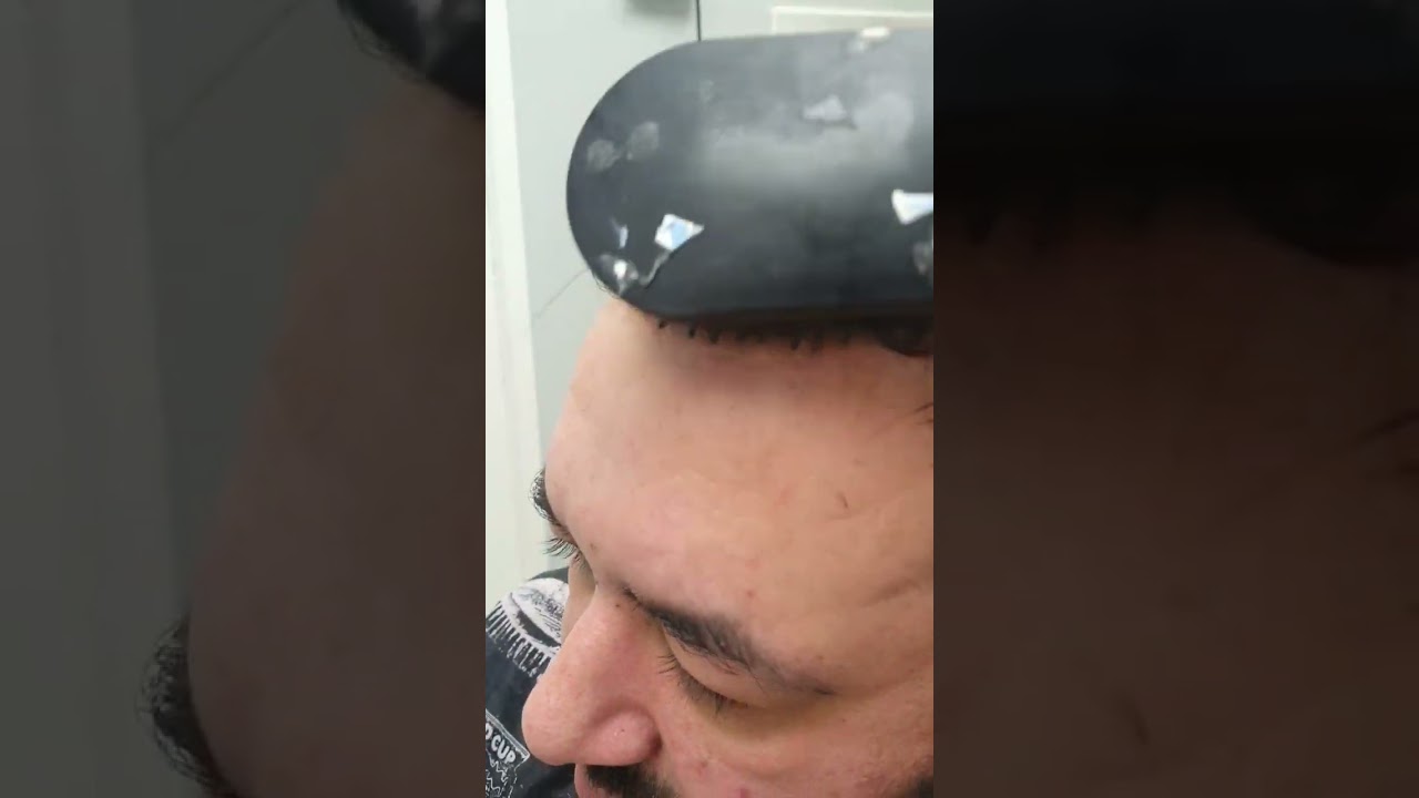 Hair replacement system at 3 months! Undetectable, black hair bleached knots, Graduated hairline