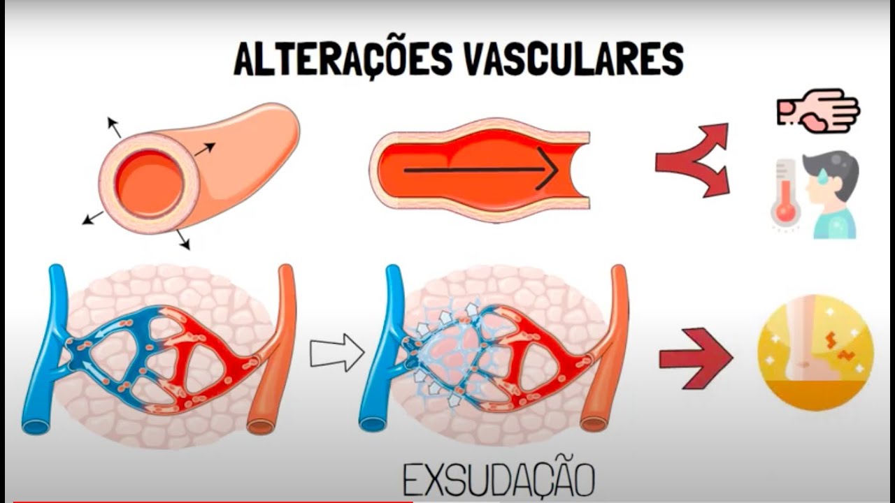 Inflamação Aguda
