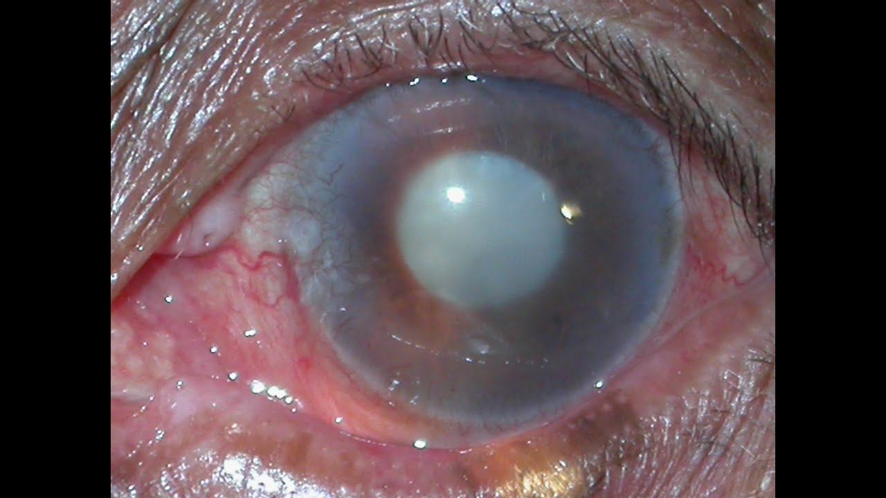 Eye Lectures; Acquired Cataract