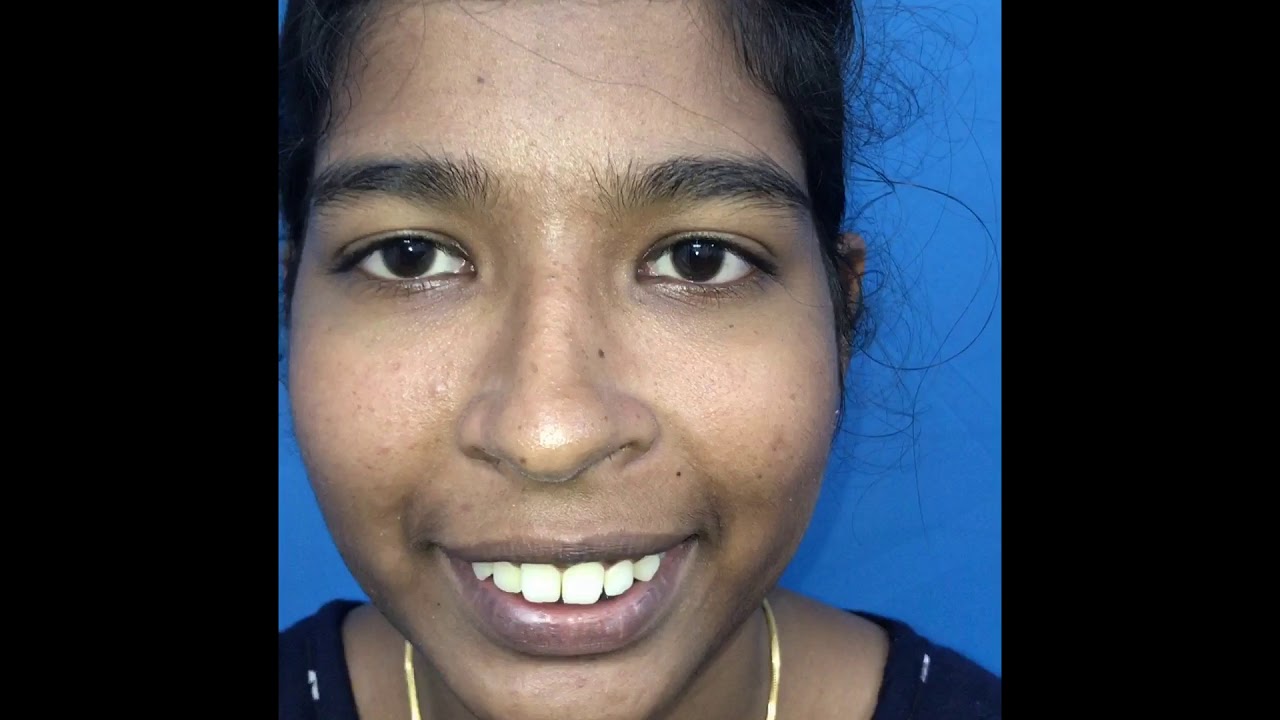 Orthognathic Surgery In INDIA | Best Jaw Surgeon at Richardsons Face Hospitals