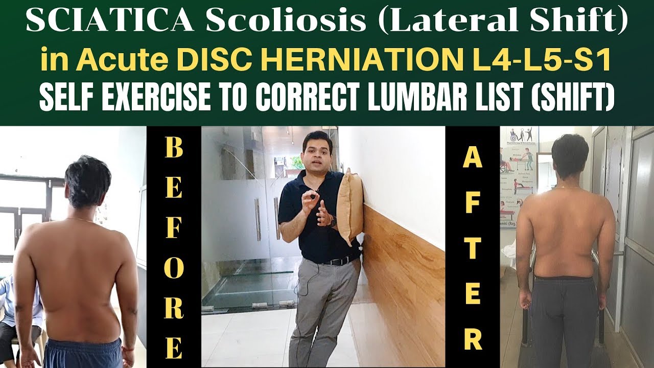 Sciatica Scoliosis, Lumbar Disc Herniation L4-L5-S1, Lateral Shift (LIST) Self Correction Exercise