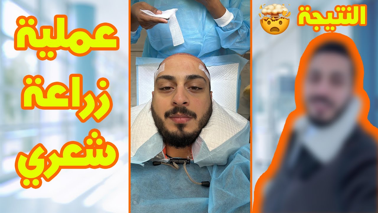 تفاصيل عملية زراعة شعر وليد | راح تنصدموا من النتيجة 🤯