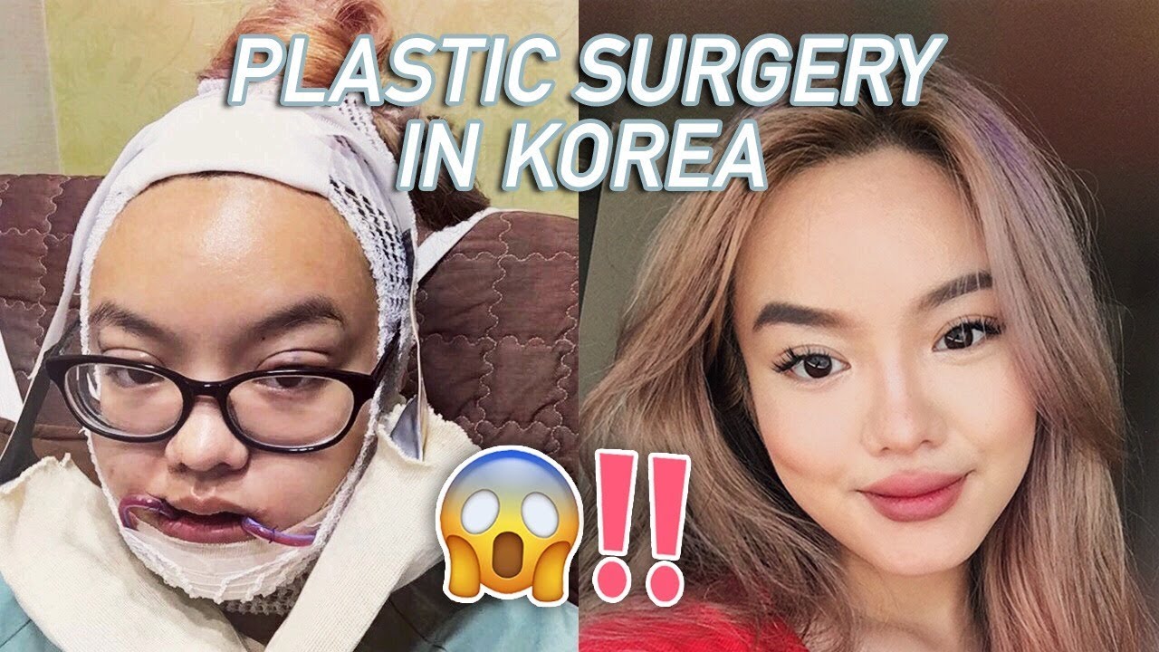 I GOT PLASTIC SURGERY IN KOREA💀: PT. 1