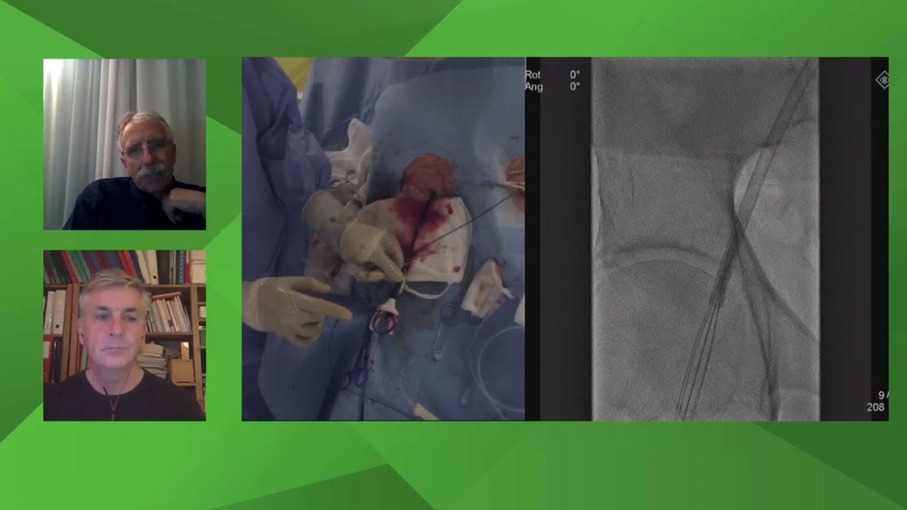 Patient with symptomatic AS using the THV Portico device with the FlexNav delivery system - Webinar