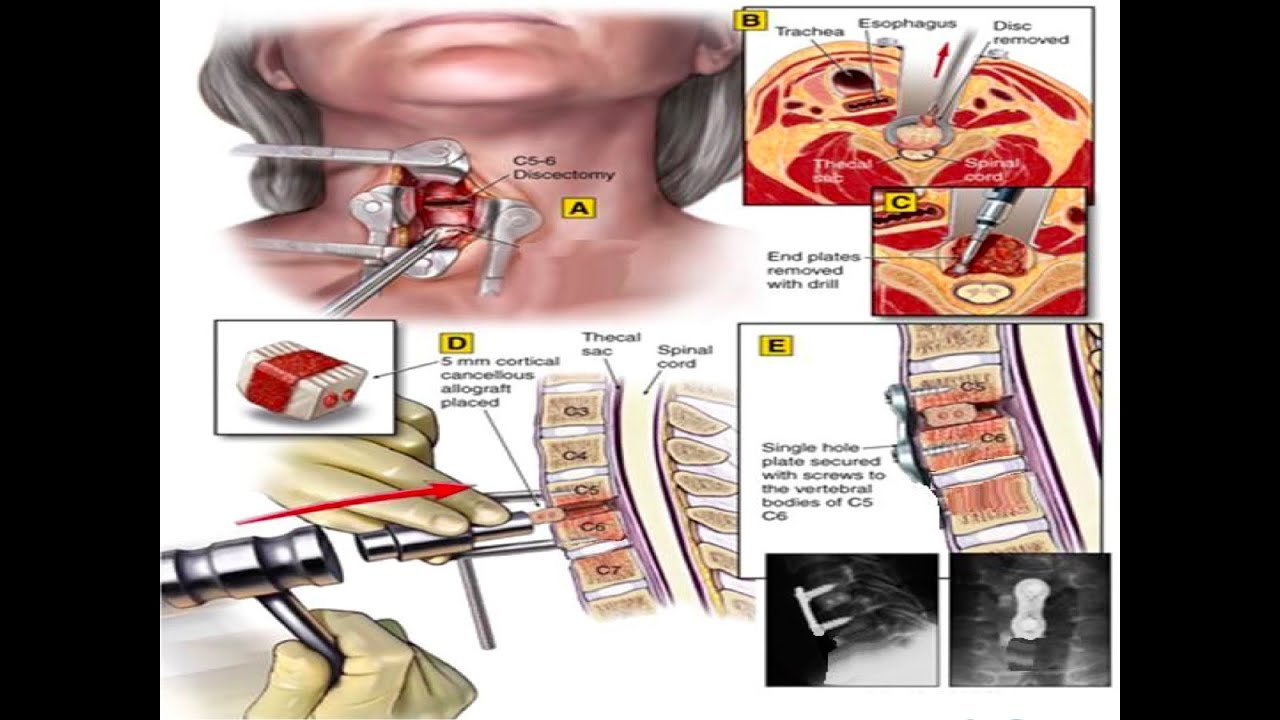 Degenerative Spine (19: ) Cervical Disc Prolapse (2)  الانزلاق الغضروفي العنقي