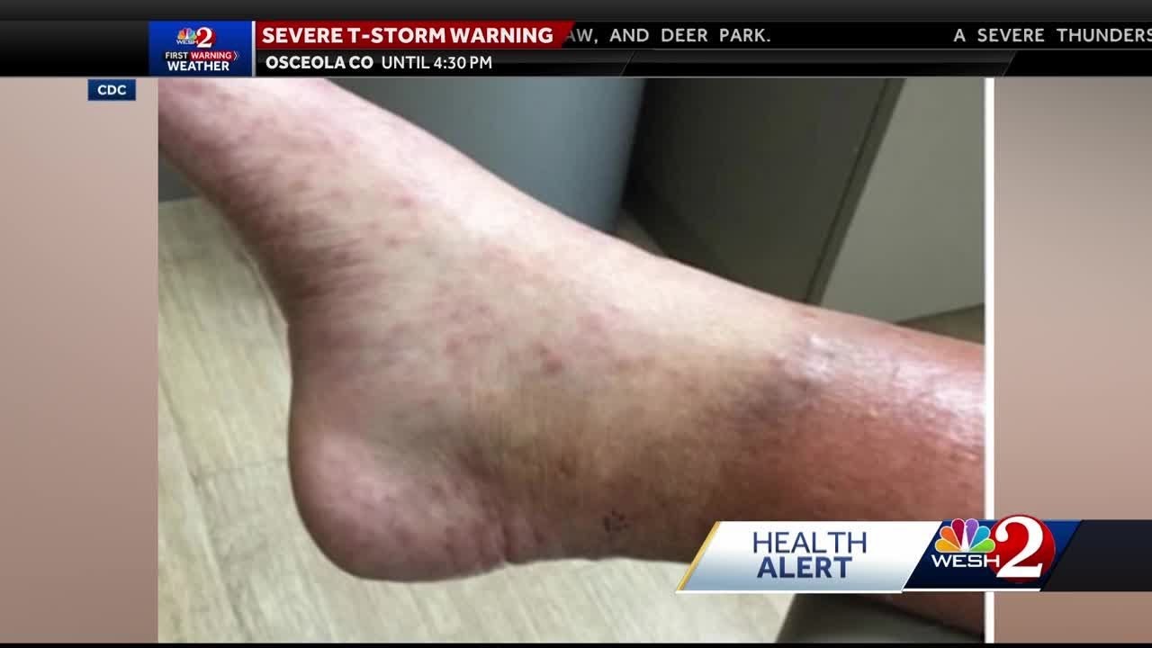 Florida one of top states for new leprosy cases: CDC letter says