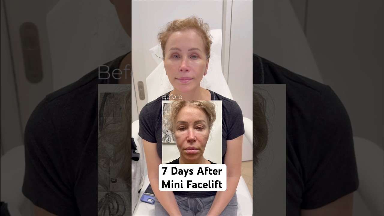 Just 7 DAYS After 😳 #minifacelift