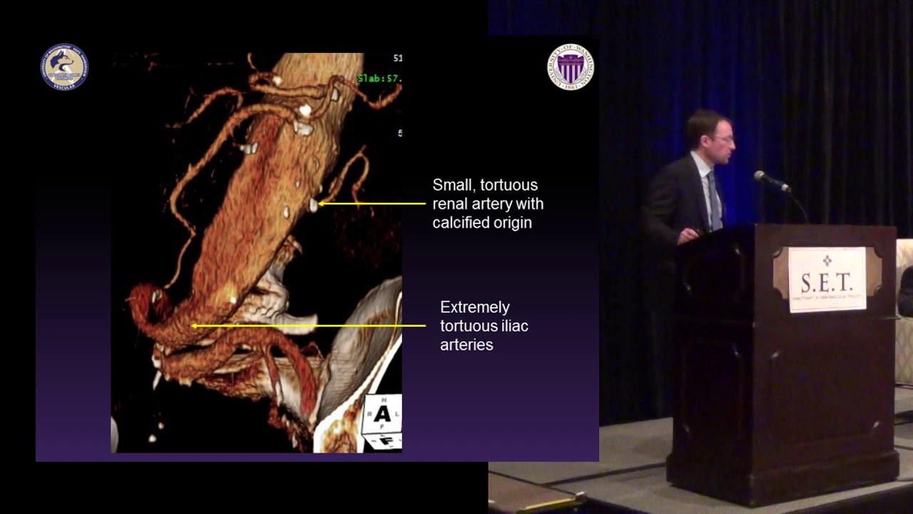 Tips and Tricks for Fenestrated EVAR