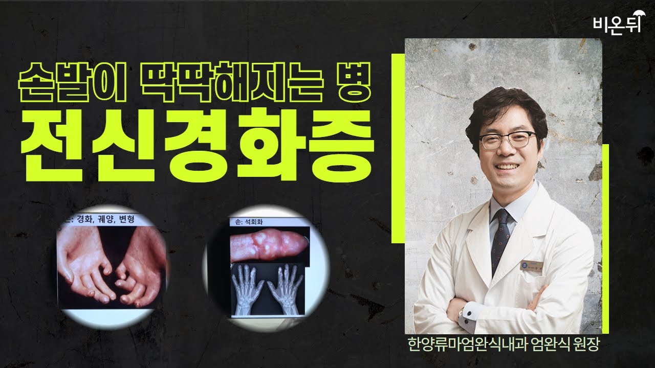 손발이 딱딱해지는 병, 전신경화증 (한양류마엄완식내과 엄완식 원장)