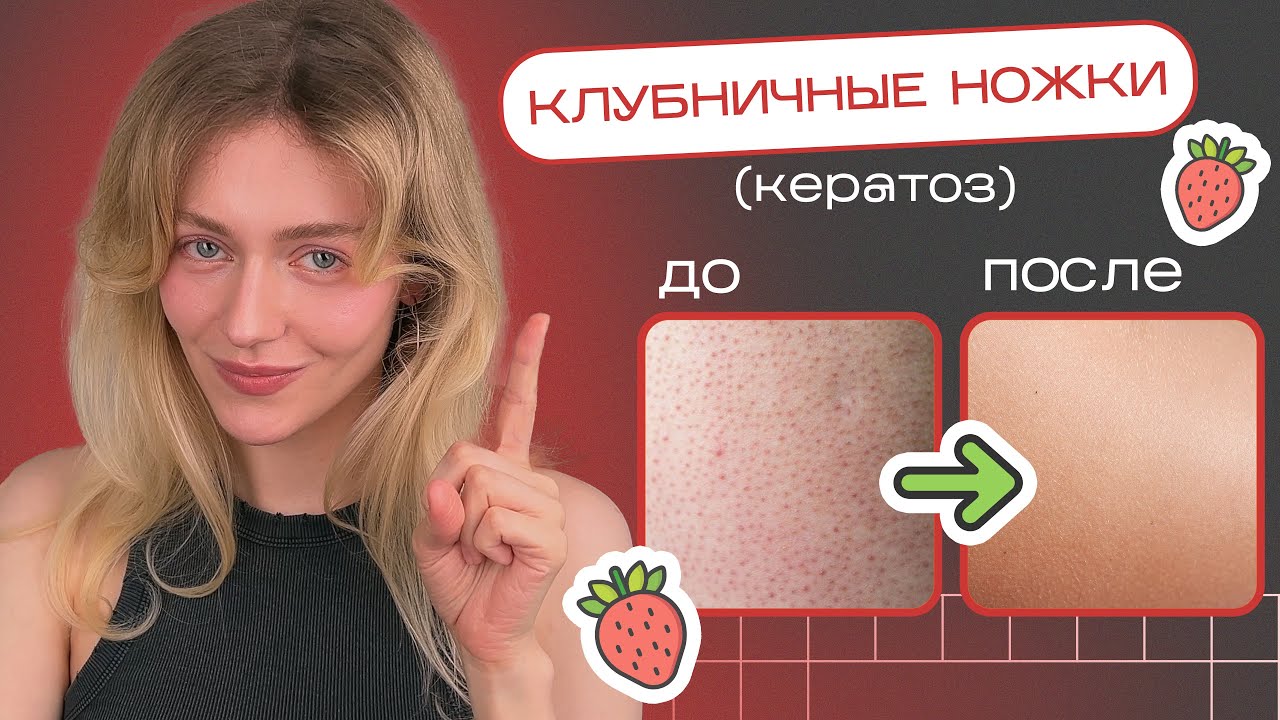 Как избавиться от КЕРАТОЗА и ВРОСШИХ ВОЛОС навсегда