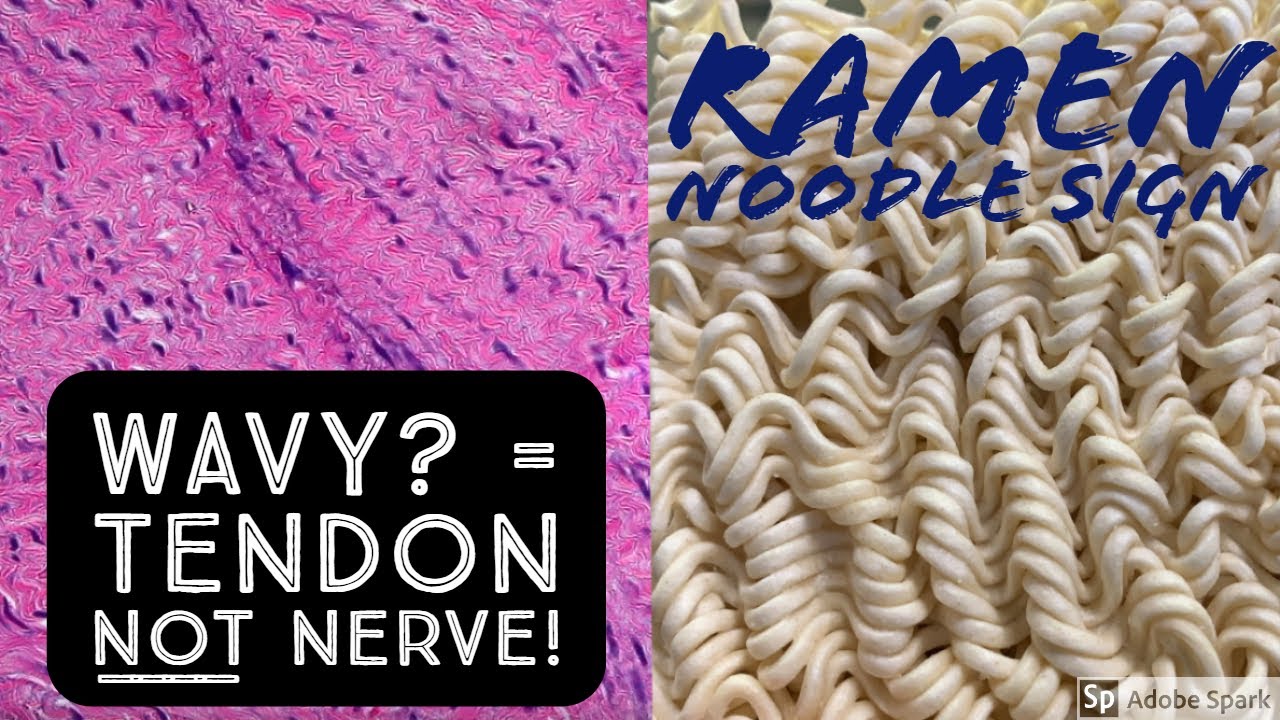 Tendon vs Nerve Histology Made Simple with the Ramen Noodle Sign (of Fulton)