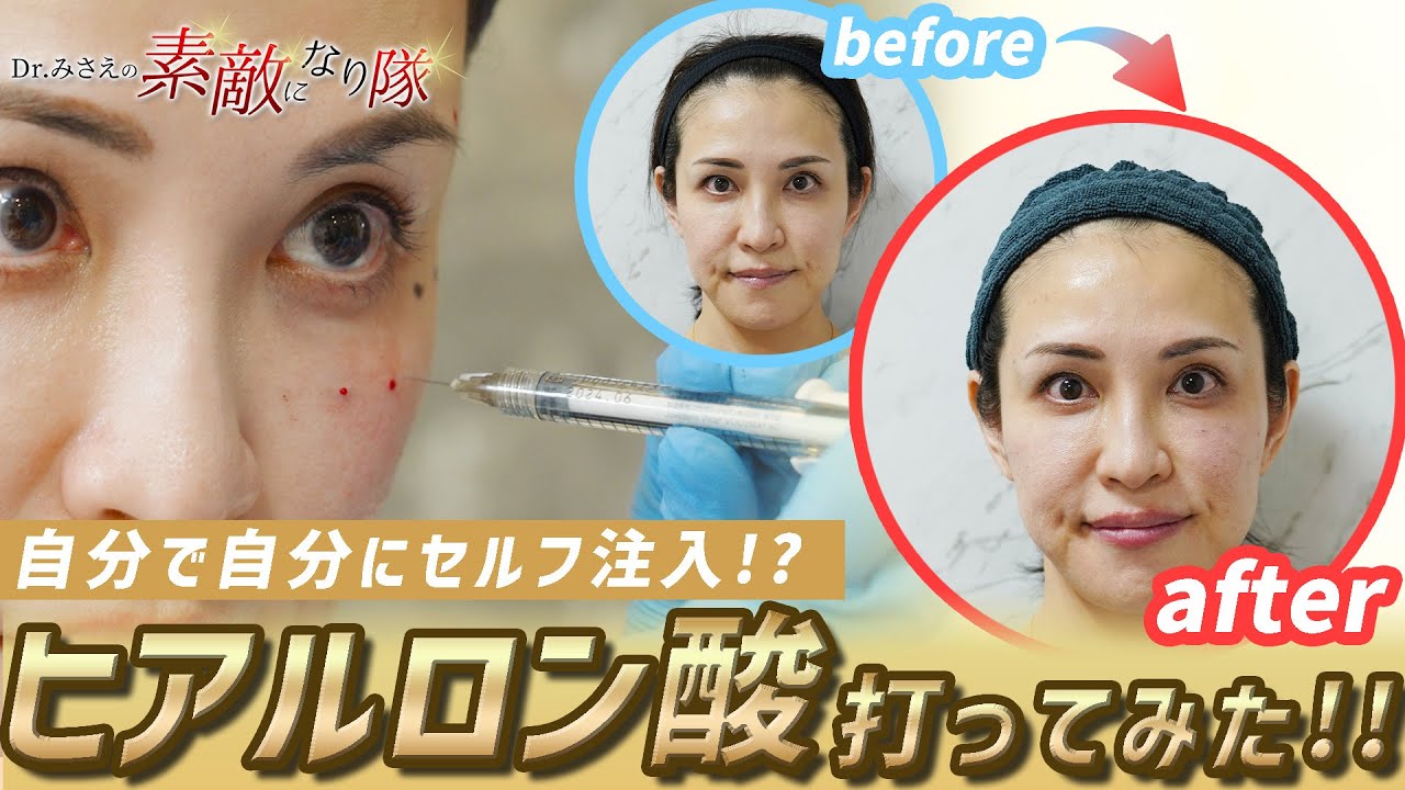 【目指せ-10才】ヒアルロン酸リフトで自然な若返り!!セルフ注入でアンチエイジング方法を実演します♪【リフトアップ】