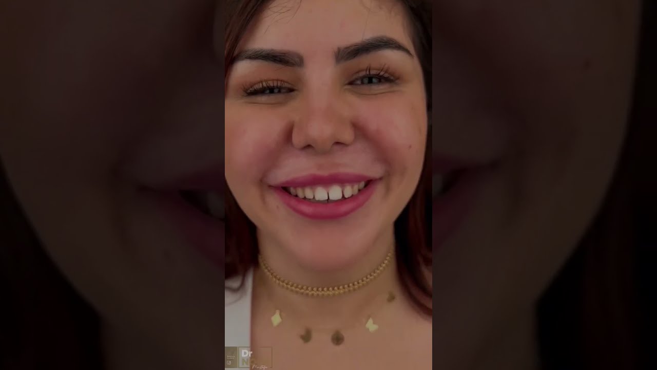 😊 التجميل في عيادة دكتور نور 😍 تجميل الاسنان في مصر خلى ابتسامتك بتلمع