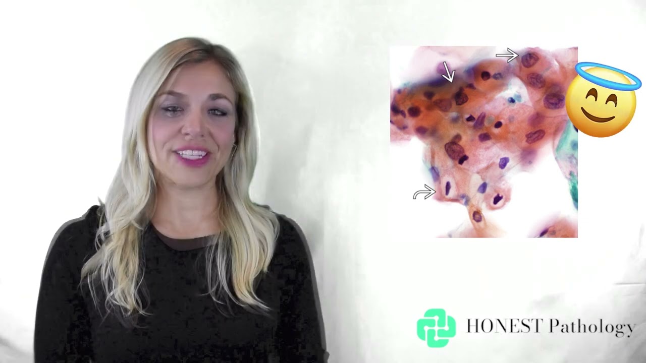 Pap Smear Results explained by a Pathologist: 4 Minute Path Report