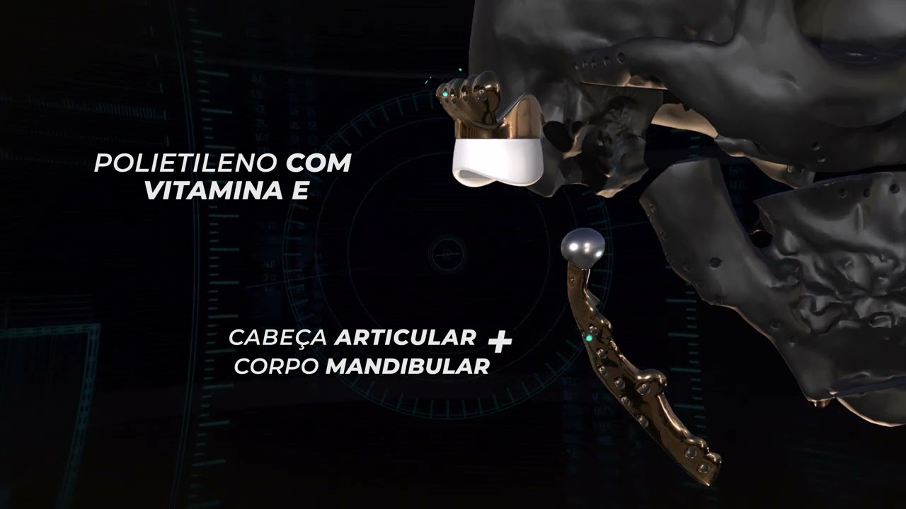 Conheça mais detalhes sobre esse caso de substituição da ATM associado a Ortognática.