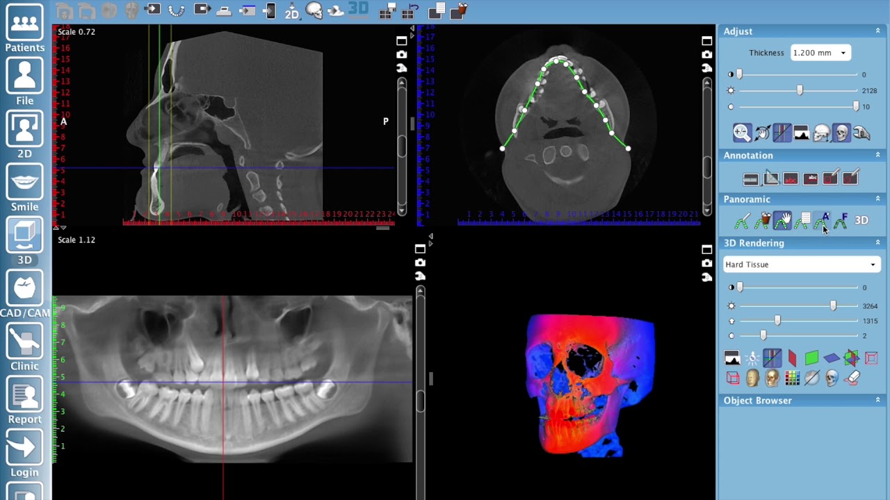 Creating a pseudo panoramic view of 3D volume in Planmeca Romexis®