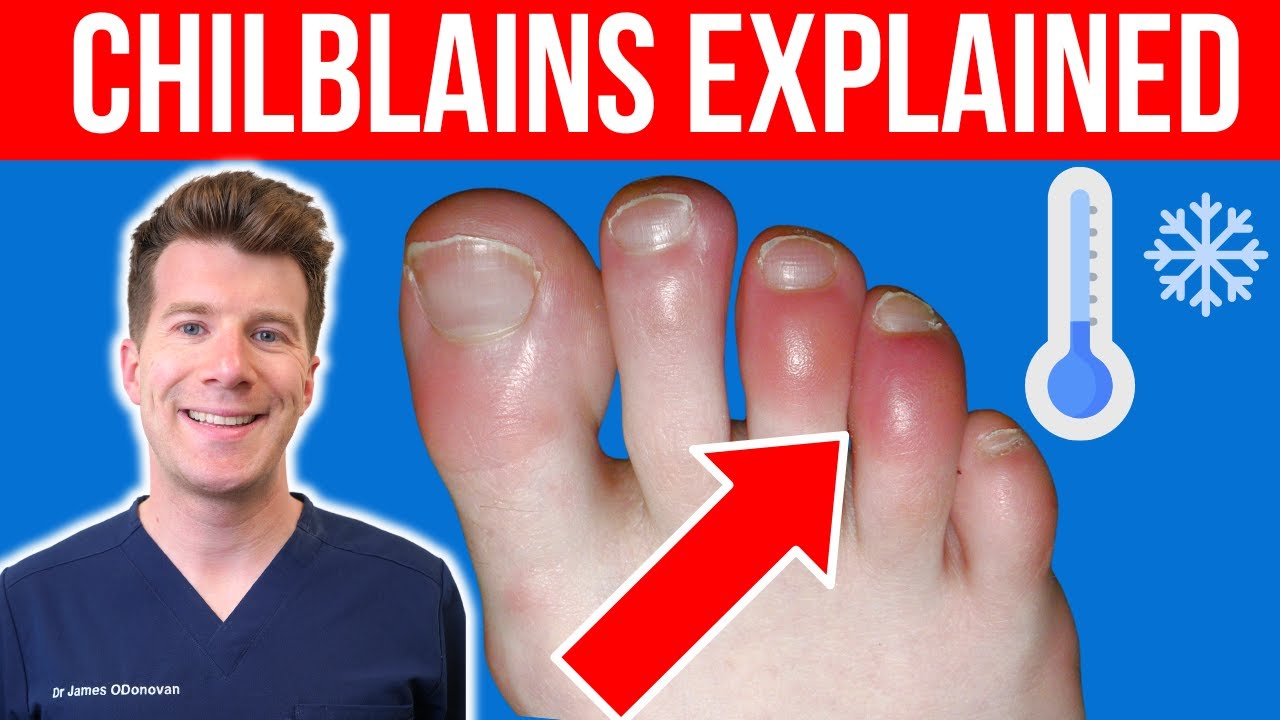 Doctor explains CHILBLAINS (Pernio) | Causes, symptoms and treatment