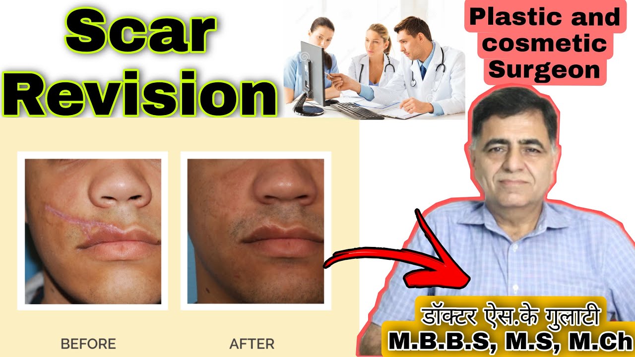 Scar revision surgery in Kanpur // Dr. S.K. Gulati
