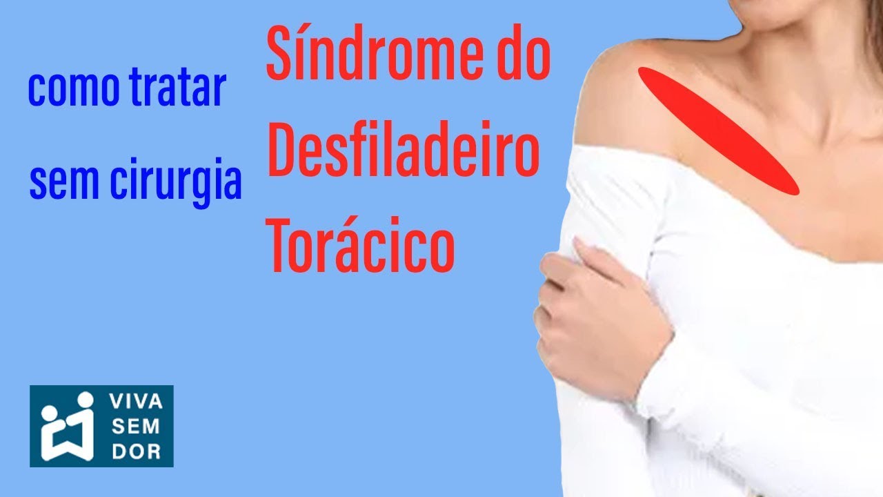 Como tratar síndrome do desfiladeiro torácico sem cirurgia