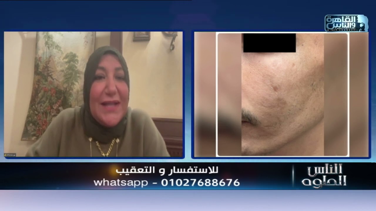 الناس الحلوة | نقل الدهون لترميم الندبات مع الدكتورة امل بركات