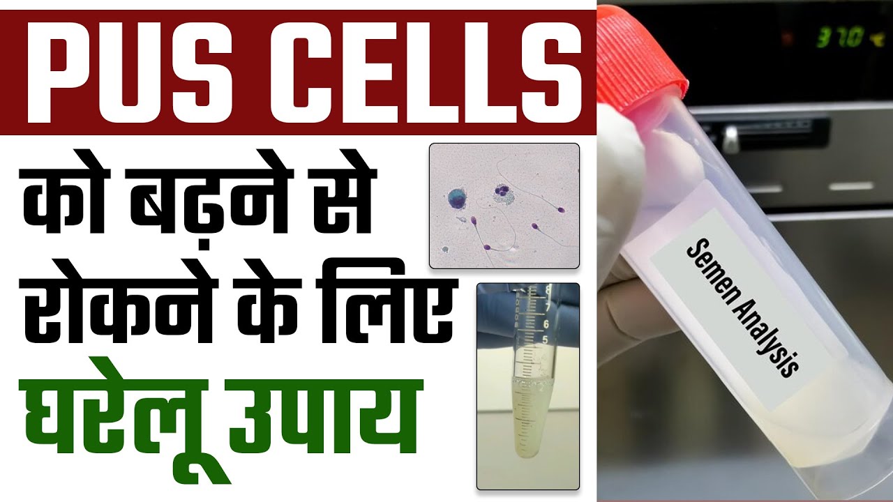 Home remedies to prevent the growth of pus cells | Causes of pus cells in semen test | Dr. Health