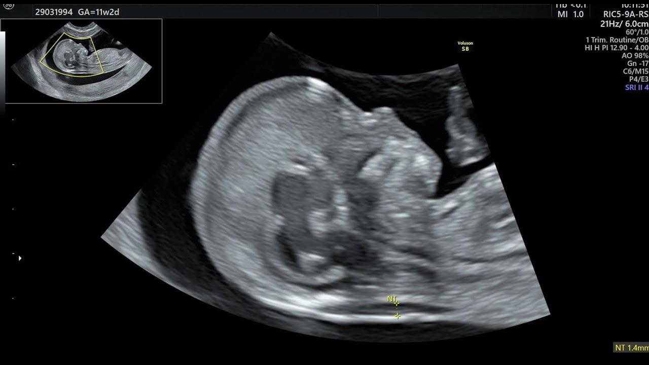 Dr Mirjana Anđelić – Ekspertni ultrazvuk i vođenje trudnoće – Beba u 12-oj nedelji trudnoće