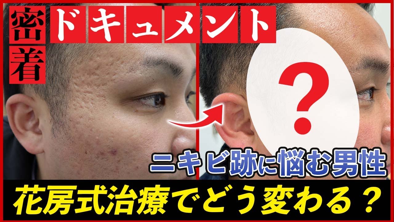 【ニキビ跡】重症なクレーター肌がどう変わる？花房式治療に密着