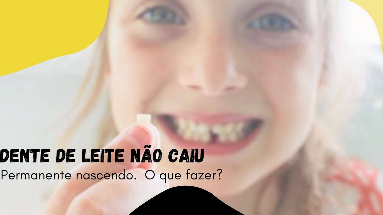 Dente permanente nascendo e de leite não caiu. O que fazer?